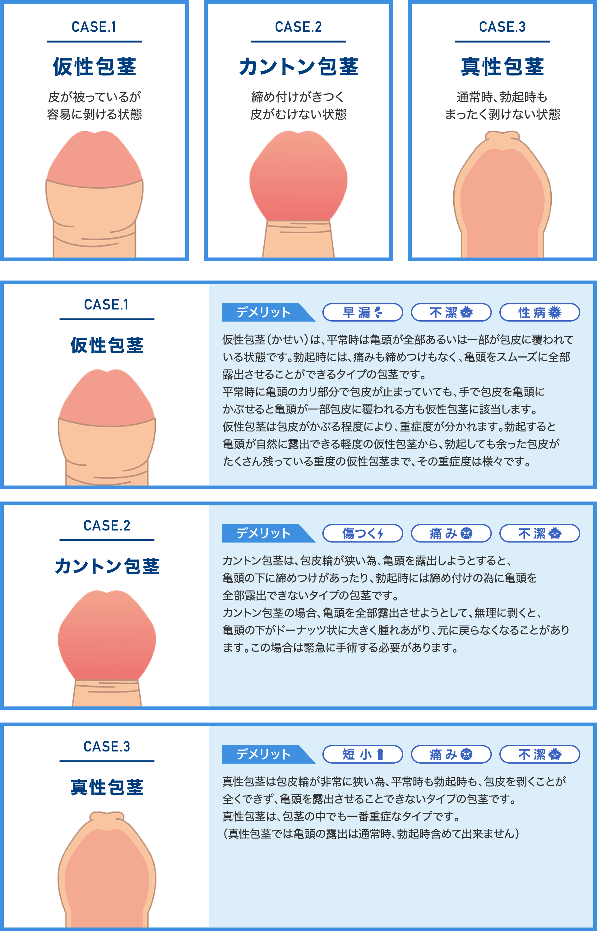 包茎とは？